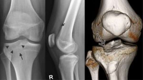 Рентген - основной способ диагностики перелома мыщелка большеберцовой кости